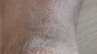 Kuru insan derisinin yakın görüntüsü
