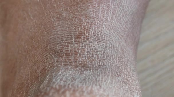 乾燥した人間の皮膚のクローズアップビュー — ストック動画