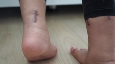 Çocuk ayağında dikiş izi var.