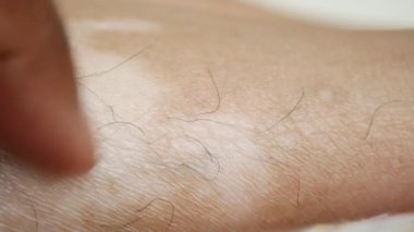  ayaklar ve vitiligo cilt durumu