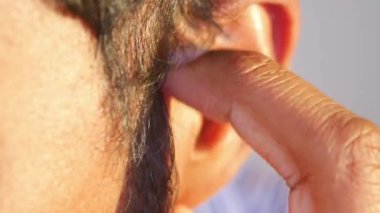 Saçında kepek olan bir adam, yakın plan. .