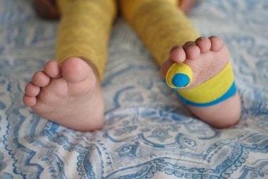 Elastik tedavi amaçlı mavi bant çocuk bacağına uygulanır. Yaralanma için Kinesio bant terapisi.