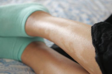  ayaklar ve vitiligo cilt durumu