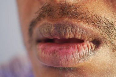 İnsan yakın planda kuru ve çatlak dudakları gösterir.