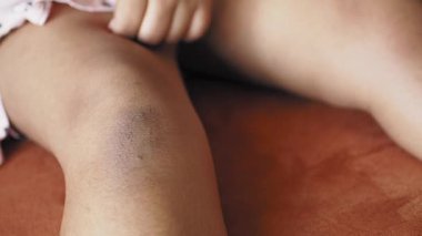 Bir çocuk, dışarıda oynadığı için dizinde gözle görülür bir çürükle dinlenir..