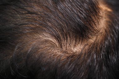 Kafa derisinde belirgin bir girdap şekli var. Taçta koyu renk saç var..