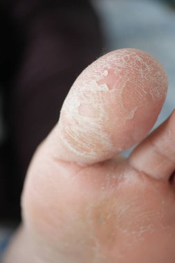 Yakından bakınca, görünürdeki doku detaylarıyla ayaktaki kuru ve çatlak deriyi gösteriyor..
