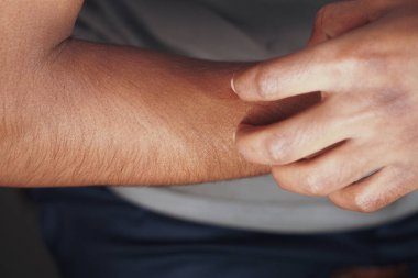 Kişi kolunu kaşıyor, muhtemelen rahatsızlık ya da kaşıntı hissediyor..