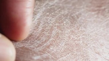 Kuru cilde dokunan bir parmağın yakın çekimi. 