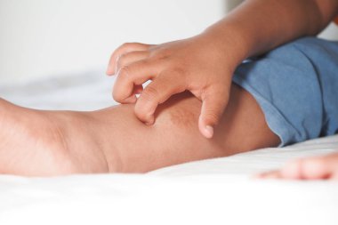 Bir çocuk yatakta otururken kaşınan bacağını kaşıyor..