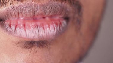 Soğuk havada kuru dudakları tedavi etmek için etkili ilaçlar ve ipuçları arayın..