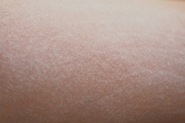 Kuru cilt dokusu doğal detayları ve kalıpları gösteriyor,