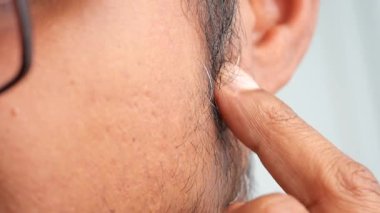 Close-up of dandruff on a man facial hair .
