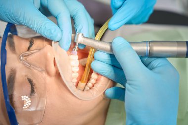 Naylon diş fırçasıyla dişlerin ön dişlerini parlatan azot eldivenli diş hekimlerinin yakın çekimi.