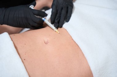 Kozmetik uzmanı, kozmetoloji kliniğinde çalışan bir kadının karnına koruyucu eldiven uzmanı olarak iğneler yapıyor.