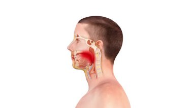 Boğaz ağrısı, iltihaplanma, kızarıklık ve boğazda şişkinlik, bademcik ve gırtlakta ağrı ve yutma güçlüğü gösteren tıbbi bir örnek. 2d, 3d