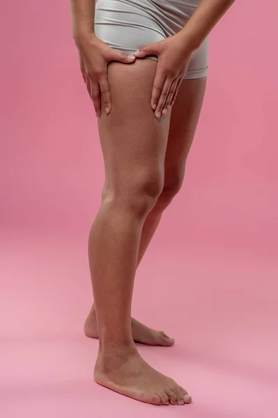 Celulitis Primer Plano Mujer Comprobando Sus Piernas Celulitis — Foto de Stock