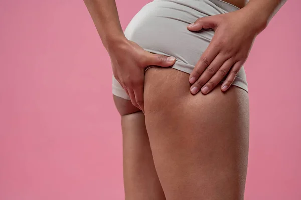Zellulitis Nahaufnahme Einer Frau Die Ihre Beine Auf Cellulitis Kontrolliert — Stockfoto