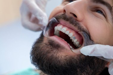 Tedavi sırasında dişçi muayenehanesinde dişçi aletleriyle sakallı hasta.