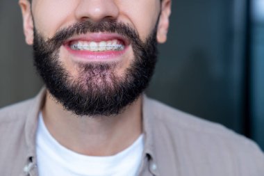 Dişçi muayenesinden sonra dişlerinde açık seramik diş telleri gösteren neşeli gülüşü olan tanınmamış bir adam.