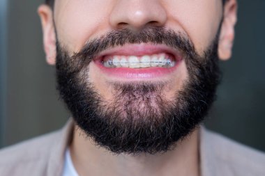 Diş sağlığı ve hijyen tedavisinden sonra dişlerinde metal diş telleri olan isimsiz bir adam.