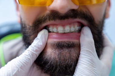 Modern diş kliniğinde diş beyazlatma prosedürleri sırasında beyaz erkek hasta.