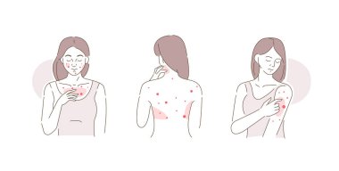 Güzellik Kızının Alerjisi ve Sivilce Sorunları Var. Vücudunu ve yüzünü eliyle kaşıyan bir kadın. Alerjik deri iltihabı, egzama ya da kaşıntı belirtileri olan isilik.