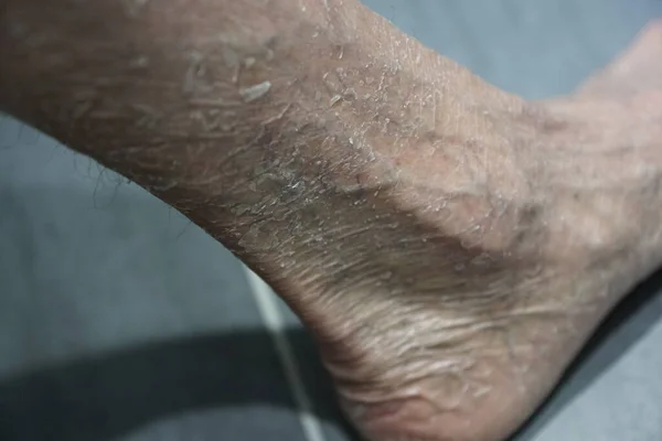 Foot of a man with the skin disease Ichthyosis