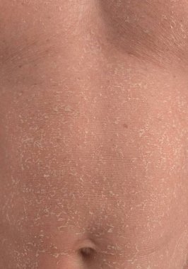 Mans Abdomen 'de Ichthyosis Cilt Kapatma Durumu