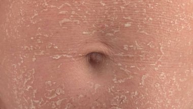 Mans Abdomen 'de Ichthyosis Cilt Kapatma Durumu