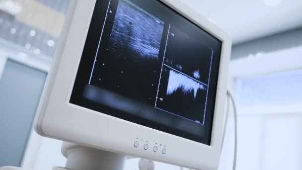 Close Ultrasound Monitor Veins Patients Lower Extremities Phlebology Varicose Veins — Stok video