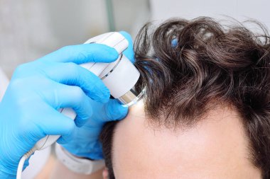 Trichoscopy is a computer examination of the scalp and hair. Close-up cosmetologist trichologist diagnoses the condition of the hair of a male patient with baldness using trichoscopy.