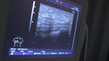 a close-up image on the monitor of the result of an ultrasound examination of the breast. Prevention of breast cancer