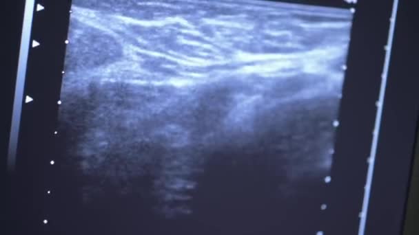 Närbild Monitorn Resultatet Ultraljudsundersökning Bröstet Förebyggande Bröstcancer — Stockvideo