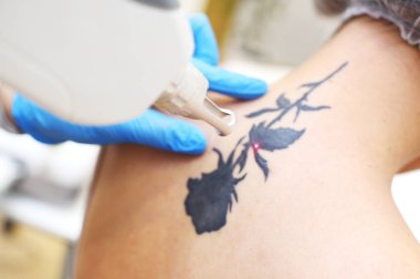 the cosmetologist removes the tattoo to the patient using a neodymium laser in a modern clinic. Hardware cosmetology