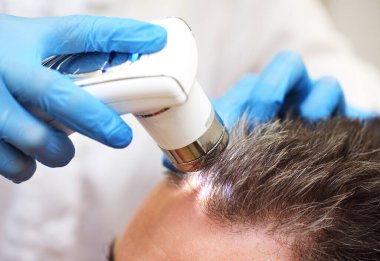 Trichoscopy is a computer examination of the scalp and hair. A cosmetologist-trichologist diagnoses the condition of a male patients hair with gray hair using a trichoscope.