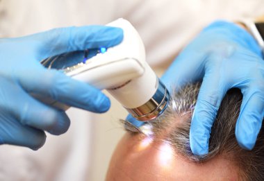 Trichoscopy is a computer examination of the scalp and hair. A cosmetologist-trichologist diagnoses the condition of a male patients hair with gray hair using a trichoscope.