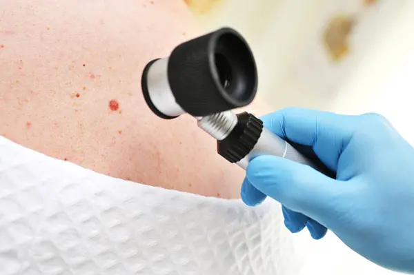 Close Een Dermatoloog Onderzoekt Moedervlekken Huidgezwellen Het Lichaam Van Patiënt Stockfoto
