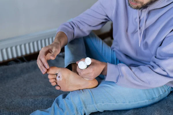 Man Applies Protective Cream Wart Plantar His Foot Cauterizing Celandine — Zdjęcie stockowe