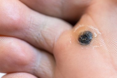 Closeup of dead skin around wart plantar after cauterizing it with celandine on infected foot. Hygiene, human skin disease, papillomavirus or HPV concept. Self-medication. 