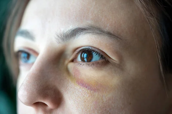 Misshandelte Hilflose Verängstigte Ehefrau Mit Augenhämatomen Die Häusliche Gewalt Aggression — Stockfoto