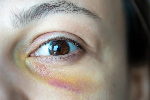 Close Eye Bruise Hematoma Young Woman Suffered Domestic Violence Part — Stock Photo, Image