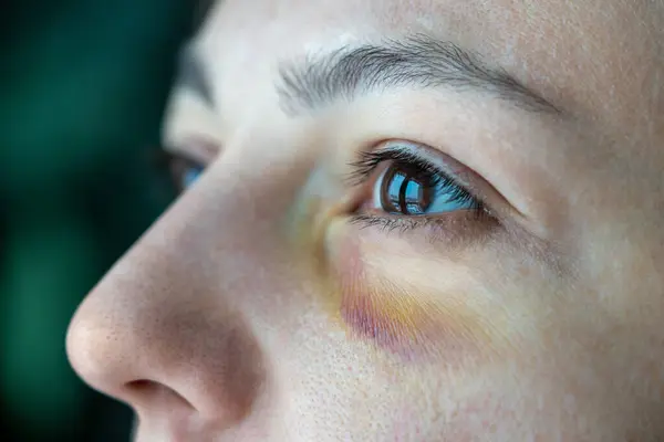 Injured Wife Bruise Eye Suffering Domestic Violence Aggression Bullying Unhappy — Stock Photo, Image