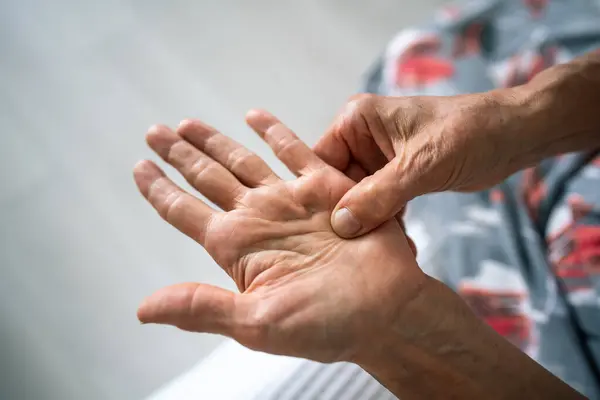 stock image Dupuytren contracture and protuberance on palm. Elderly woman rubs, feels tender hand with stiff knot under ring finger. Senior female has trouble bending finger. Hand tendon malady, stiff knot.