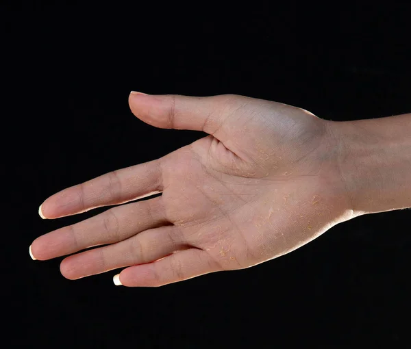 Ξηρά Χέρια Ξεφλουδίζουν Δέρμα Στα Χέρια Και Δάχτυλα Αλλεργία Στον — Φωτογραφία Αρχείου