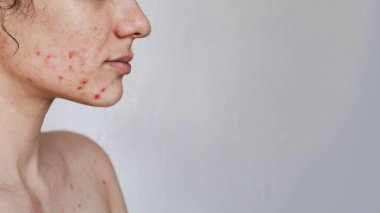 Sorunları olan genç bir kızın derisine yakın çekim. Sivilceler, sivilceler, gözenekler, yaralar. Filtresiz doğal deri. Metnin için bir yer