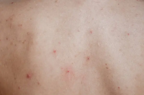 Close-up of the skin of a young girl with problems. Pimples, acne, pores, scars. Natural skin without filters.