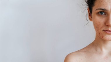 Sorunları olan genç bir kızın derisine yakın çekim. Sivilceler, sivilceler, gözenekler, yaralar. Filtresiz doğal deri. Metnin için bir yer