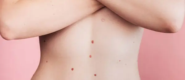 A woman\'s belly with numerous moles. The effect of the sun on the skin. Skin cancer. The panorama