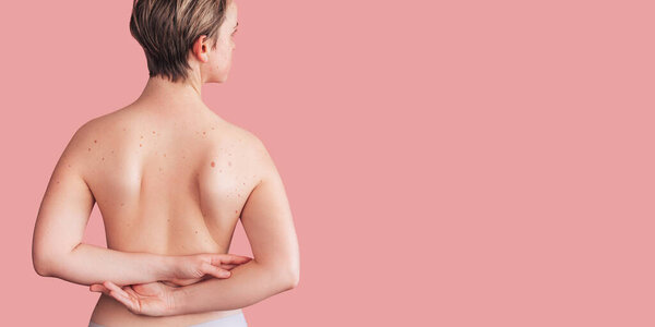 Женщины вернулись с многочисленными родинками. Влияние солнца на кожу. Рак кожи. Панорама. Место для текста